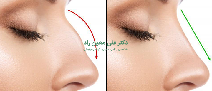 جراحی بینی چیست؟