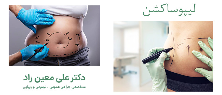 لیپوساکشن چیست؟