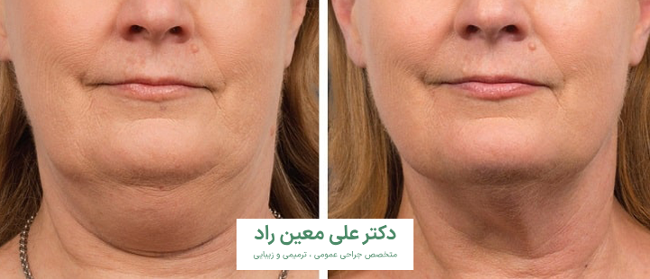 درباره اندولیفت غبغب