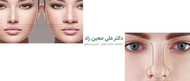آشنایی با جراحی بینی گوشتی 