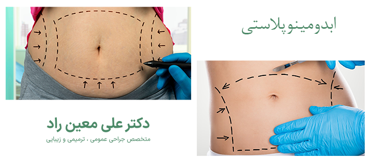 ابدومینوپلاستی چیست؟