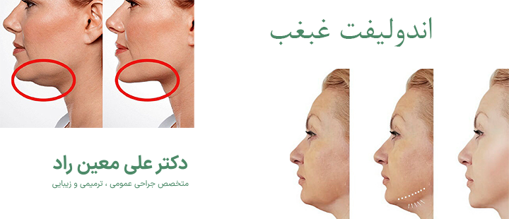 درباره اندولیفت غبغب