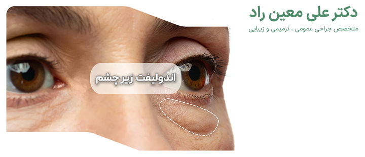 آشنایی با اندولیفت زیر چشم 