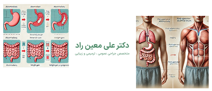 آشنایی با برگشت شکم بعد از ابدومینوپلاستی