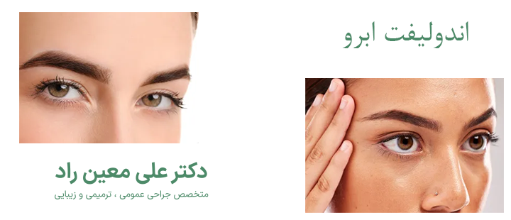 اندولیفت ابرو چیست؟