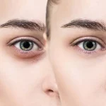 اندولیفت زیر چشم