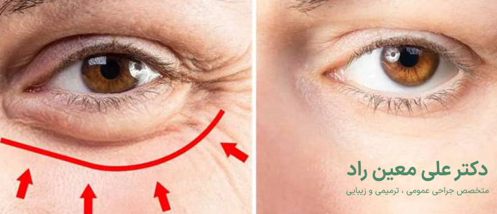 اندولیفت زیر چشم چیست؟