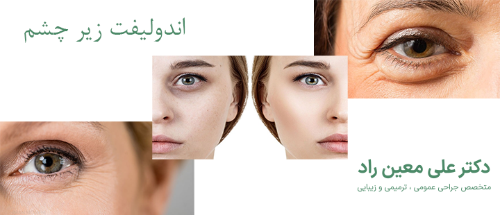 درباره اندولیفت زیر چشم