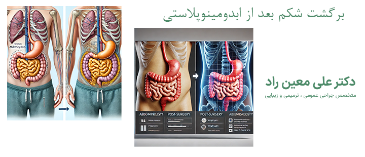 درباره برگشت شکم بعد از ابدومینوپلاستی