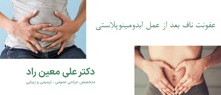درباره عفونت ناف بعد از عمل ابدومینوپلاستی