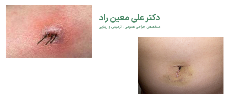 عفونت ناف بعد از عمل ابدو