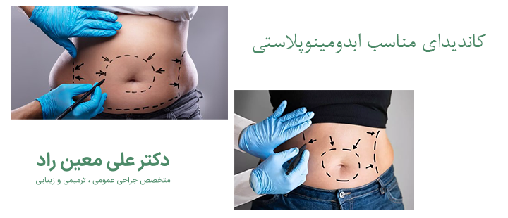 درباره کاندید مناسب ابدومینوپلاستی 
