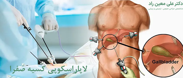 آشنایی با لاپاراسکوپی کیسه صفرا 