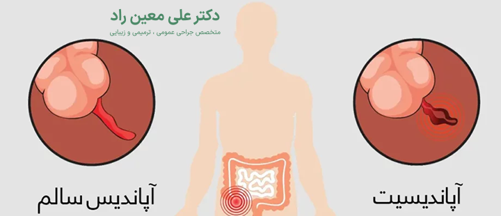 آَشنایی با عمل آپاندیس