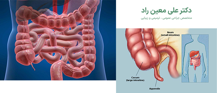 درباره عمل آپاندیس