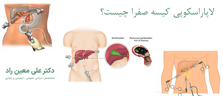 درباره لاپاراسکوپی کیسه صفرا 
