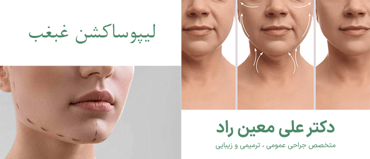 درباره لیپوساکشن غبغب 