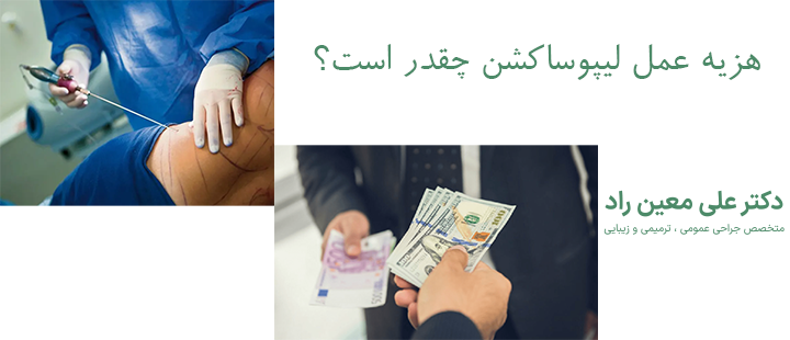 درباره هزینه لیپوساکشن 