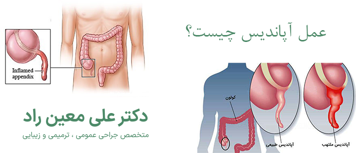 عمل آپاندیس چیست؟
