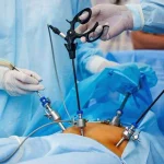 لاپاراسکوپی کیسه صفرا