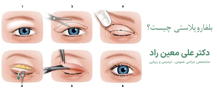 بلفاروپلاستی چیست؟