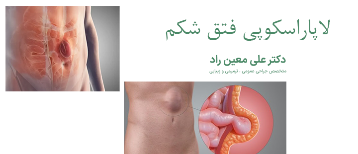 درباره لاپاراسکوپی فتق شکم