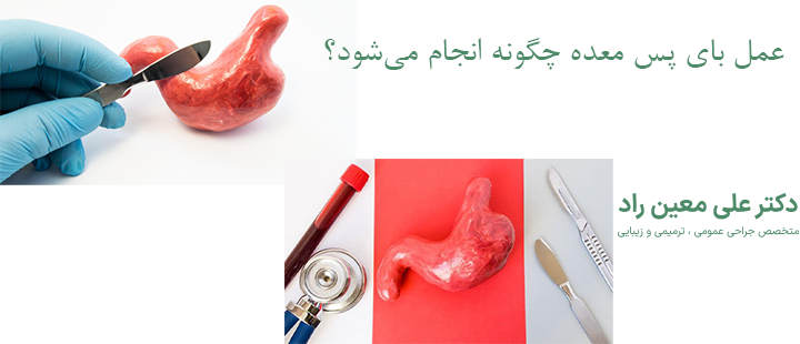 عمل بای پس معده چگونه انجام می‌شود؟
