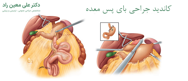 کاندید جراحی بای پس معده