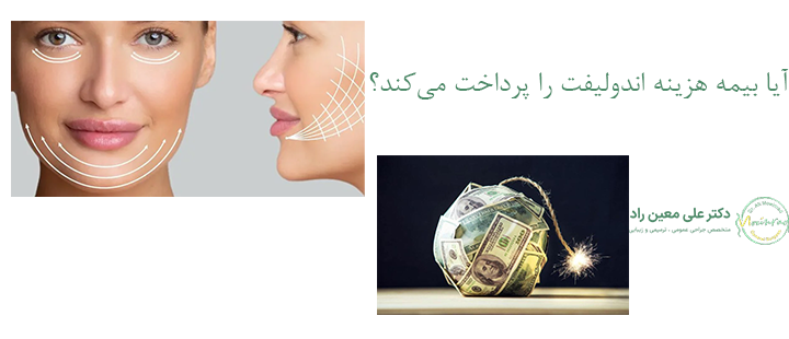 آیا بیمه هزینه اندولیفت را پرداخت می‌کند؟