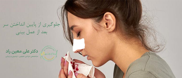جلوگیری از پایین انداختن سر بعد از عمل بینی