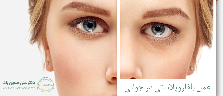 عمل بلفاروپلاستی در جوانی