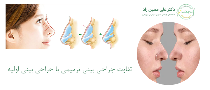 تفاوت جراحی بینی ترمیمی با جراحی بینی اولیه 