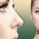 جراحی بینی ترمیمی