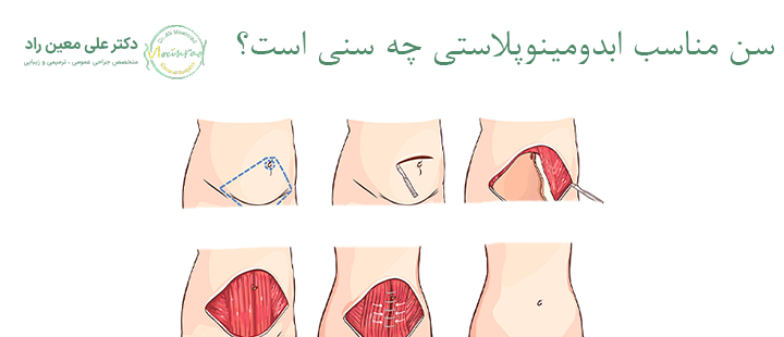 سن مناسب ابدومینوپلاستی چه سنی است؟