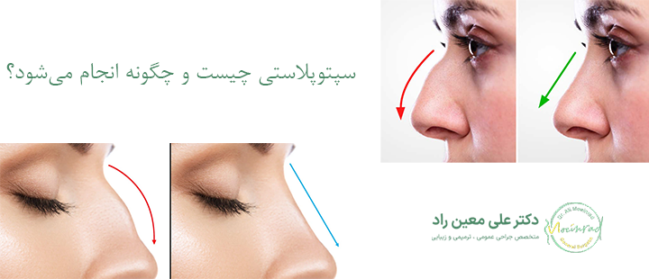 سپتوپلاستی چیست و چگونه انجام می‌شود؟