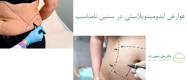 عوارض ابدومینوپلاستی در سنین نامناسب