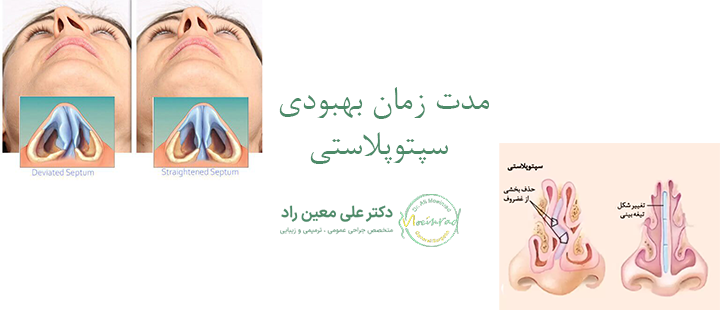 مدت زمان بهبودی بعد از سپتوپلاستی