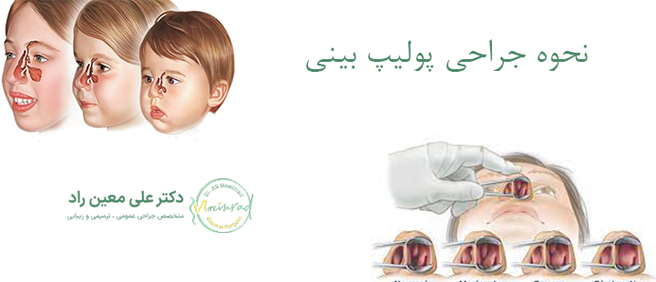نحوه جراحی پولیپ بینی 