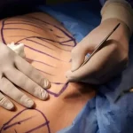 هزینه ابدومینوپلاستی