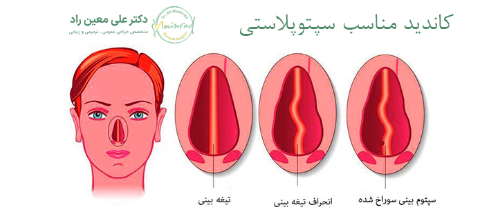 کاندید مناسب سپتوپلاستی 