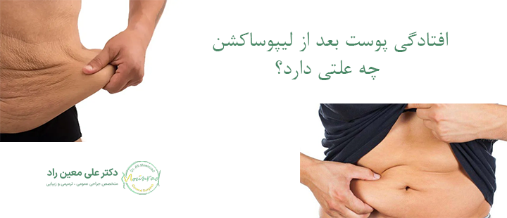 افتادگی پوست بعد از لیپوساکشن چه علتی دارد؟