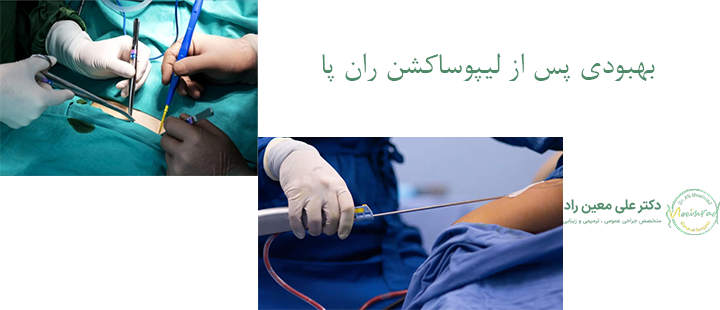 بهبود پس از لیپوساکشن ران پا