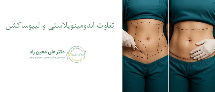 تفاوت ابدومینوپلاستی و لیپوساکشن