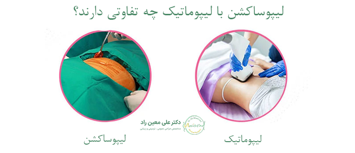تفاوت های لیپوماتیک با لیپوساکشن 