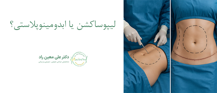 لیپوساکشن یا ابدومینوپلاستی؟