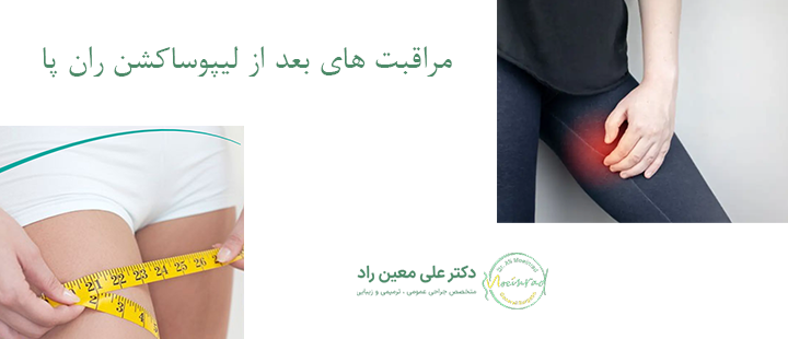 مراقبت‌ های بعد از لیپوساکشن ران پا