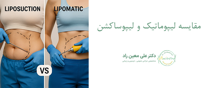 مقایسه لیپوماتیک و لیپوساکشن 