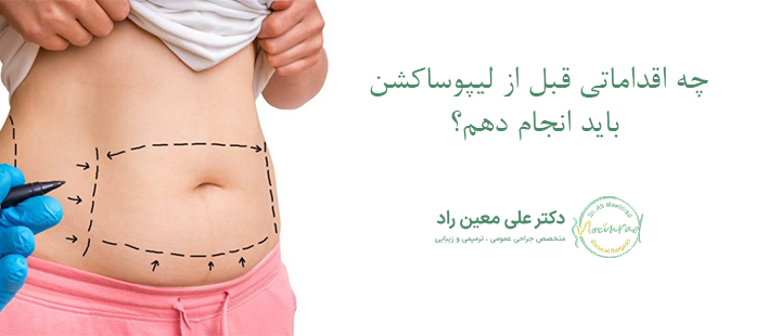 چه اقداماتی قبل از لیپوساکشن باید انجام دهم؟