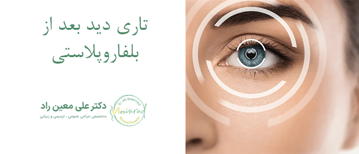 درباره تاری دید بعد از بلفاروپلاستی 