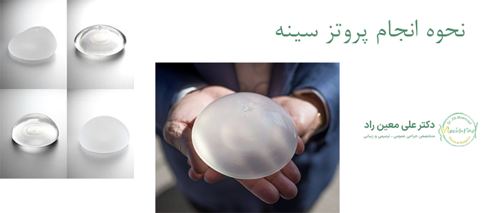 نحوه انجام پروتز سینه 